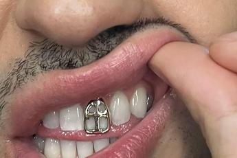 Gioielli sui denti e grillz mania possibili rischi