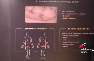 Idrosadenite suppurativa lesperto Piu attenzione a qualita della vita