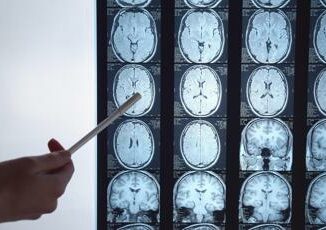 Tumori per glioblastoma nuove prospettive da immunoterapia personalizzata