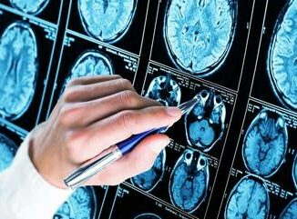 Iss scoperto meccanismo chiave Alzheimer speranza per diagnosi e cure