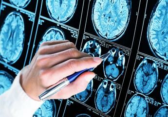 Iss scoperto meccanismo chiave Alzheimer speranza per diagnosi e cure